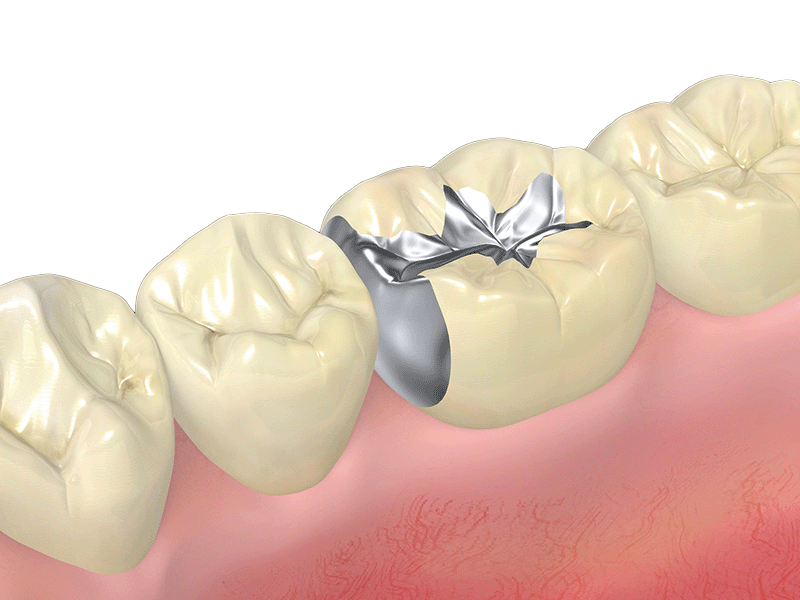 セラミック インレー