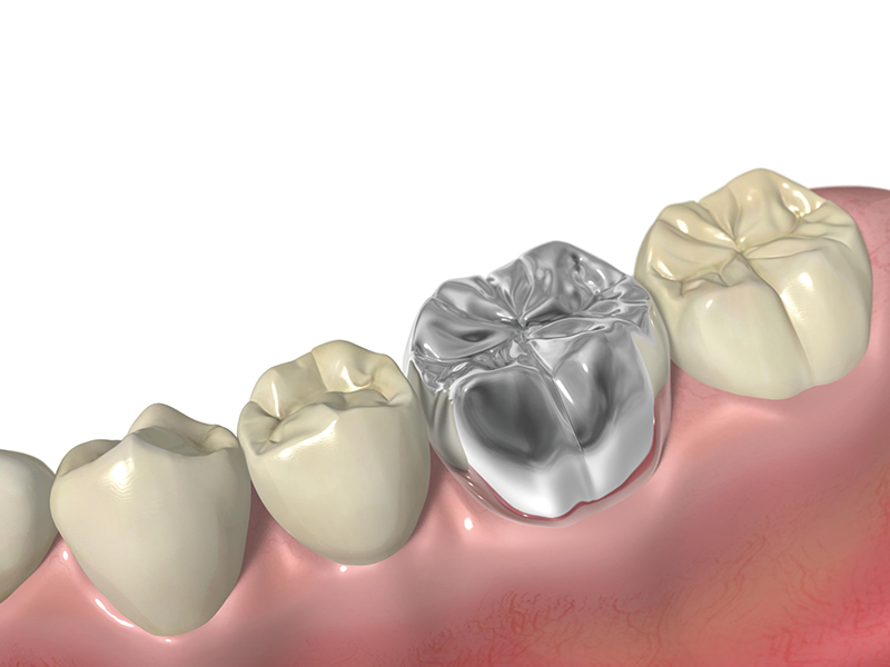 セラミック クラウン
