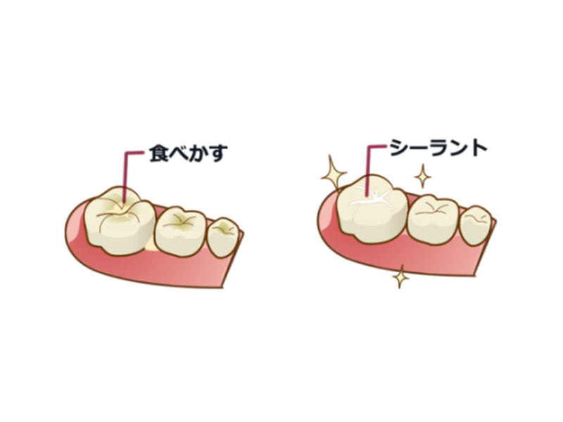 シーラント処置