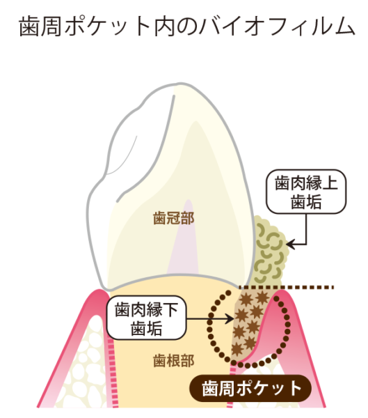 歯周ポケット