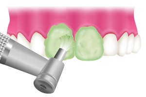 着色を落としクリーニング